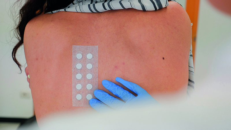 Abich-29 This image shows a patch test being applied on a person's back. The test involves small discs (usually impregnated with allergens or test substances) affixed to the skin using a strip or patch